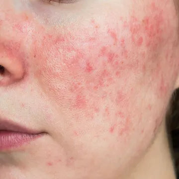 ACNE ROSACEA